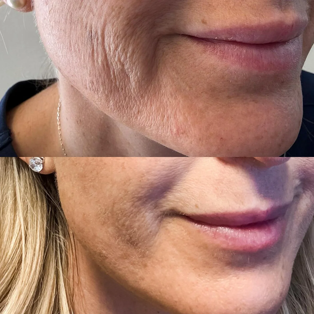 microneedling Brandy holding botox vials