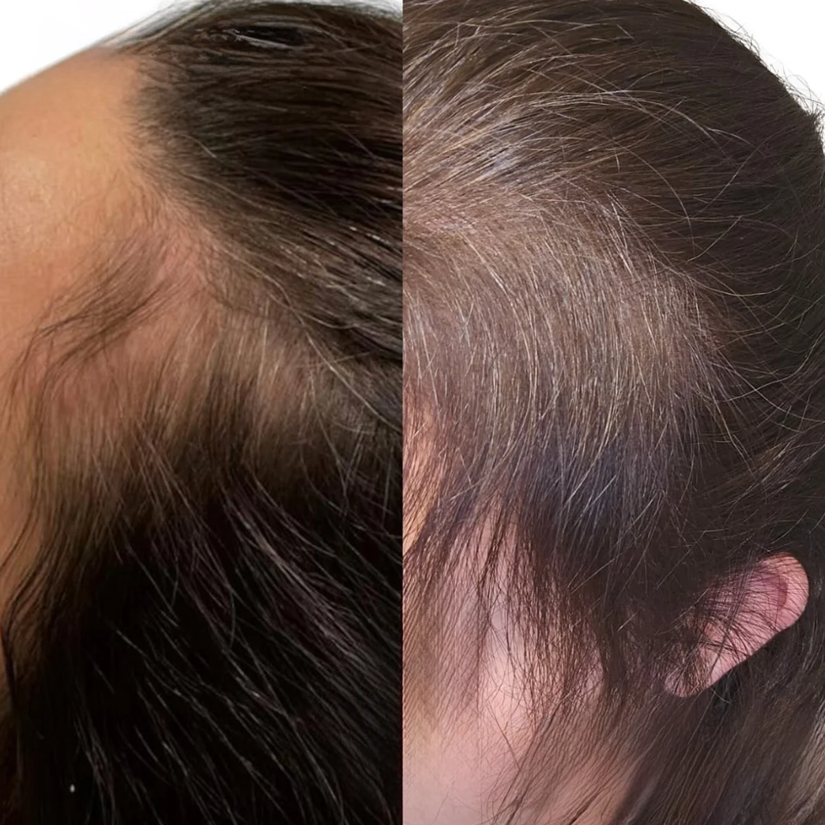 prp hair resto PRP hair restoration before and after