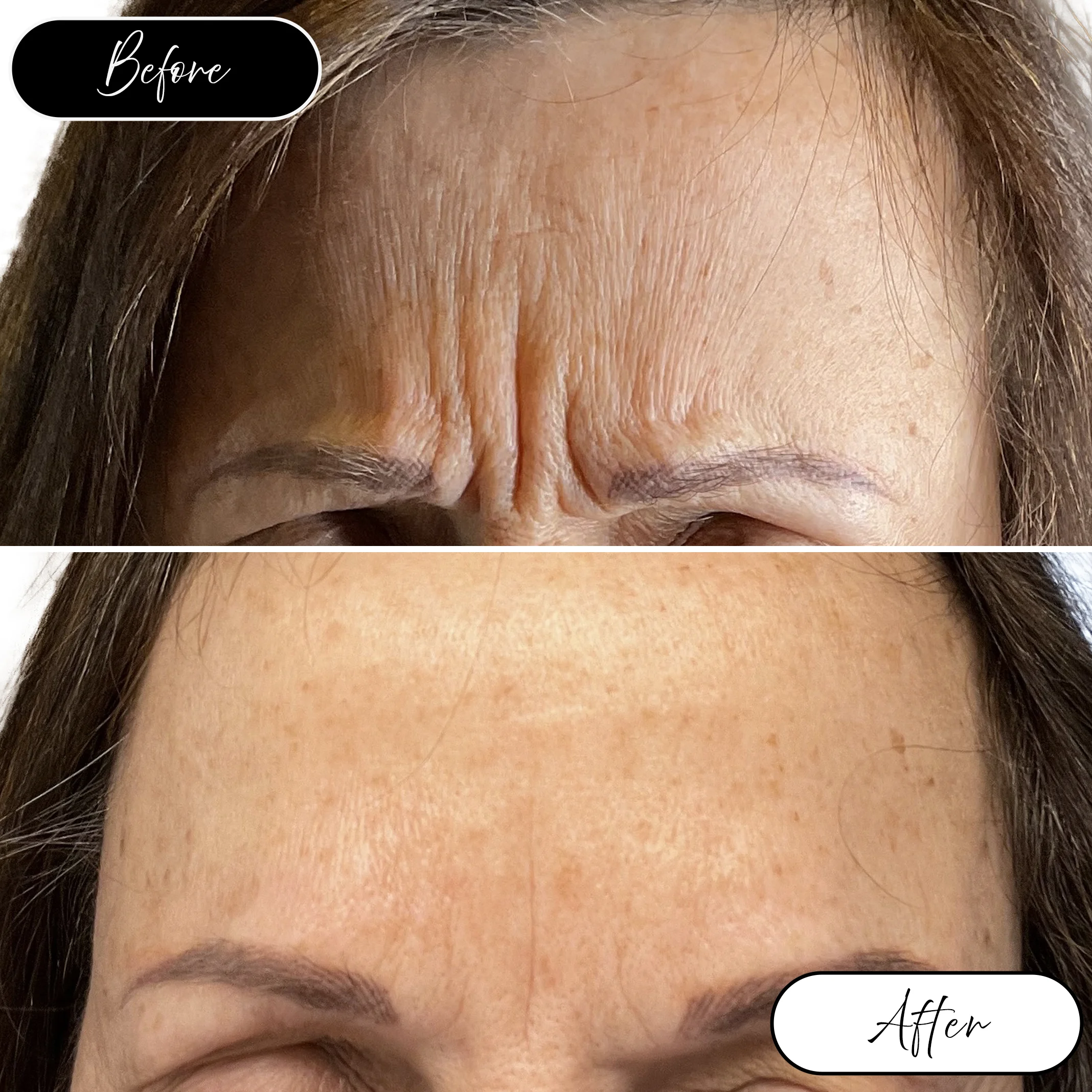 Forehead lines before and after
