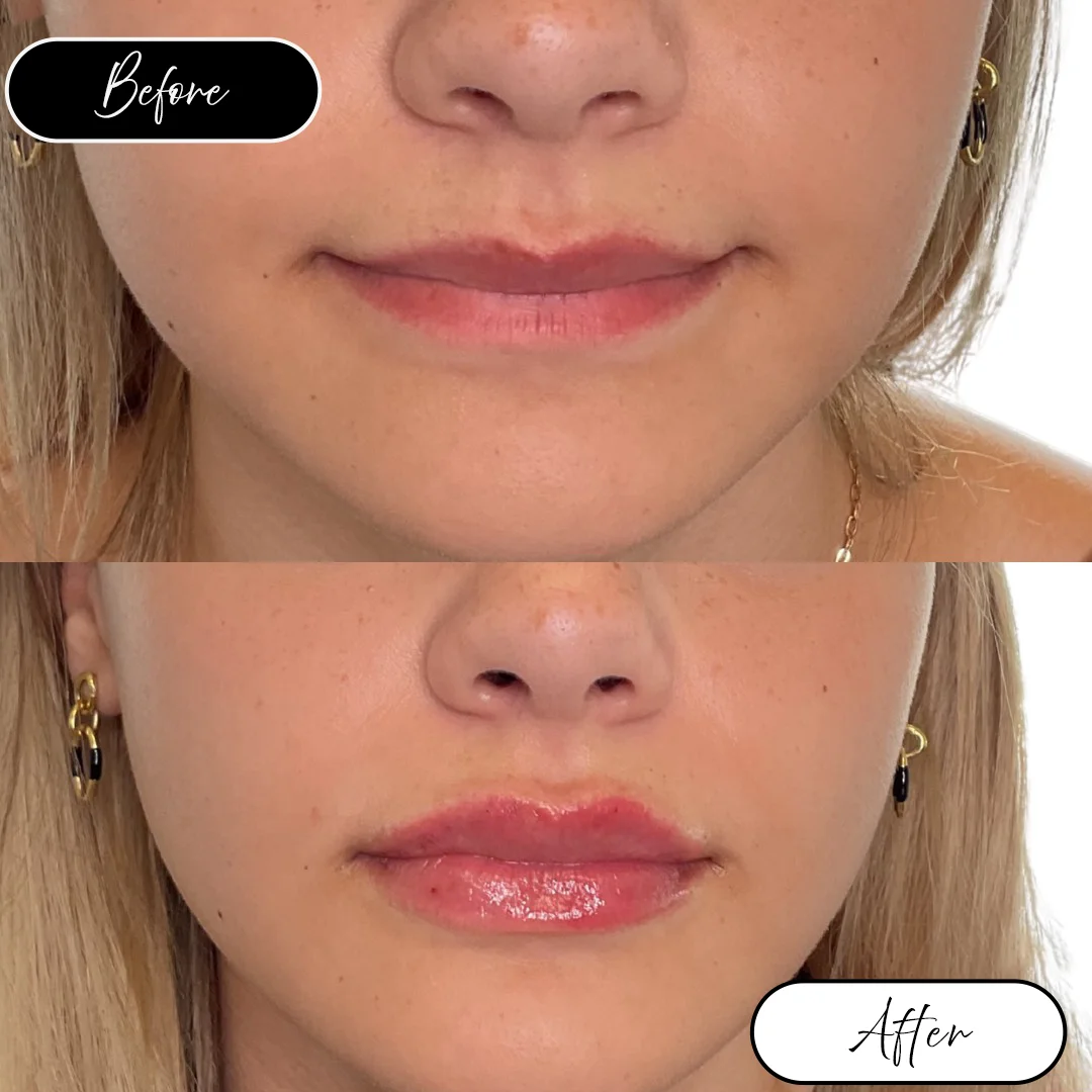 Lip filler before and after