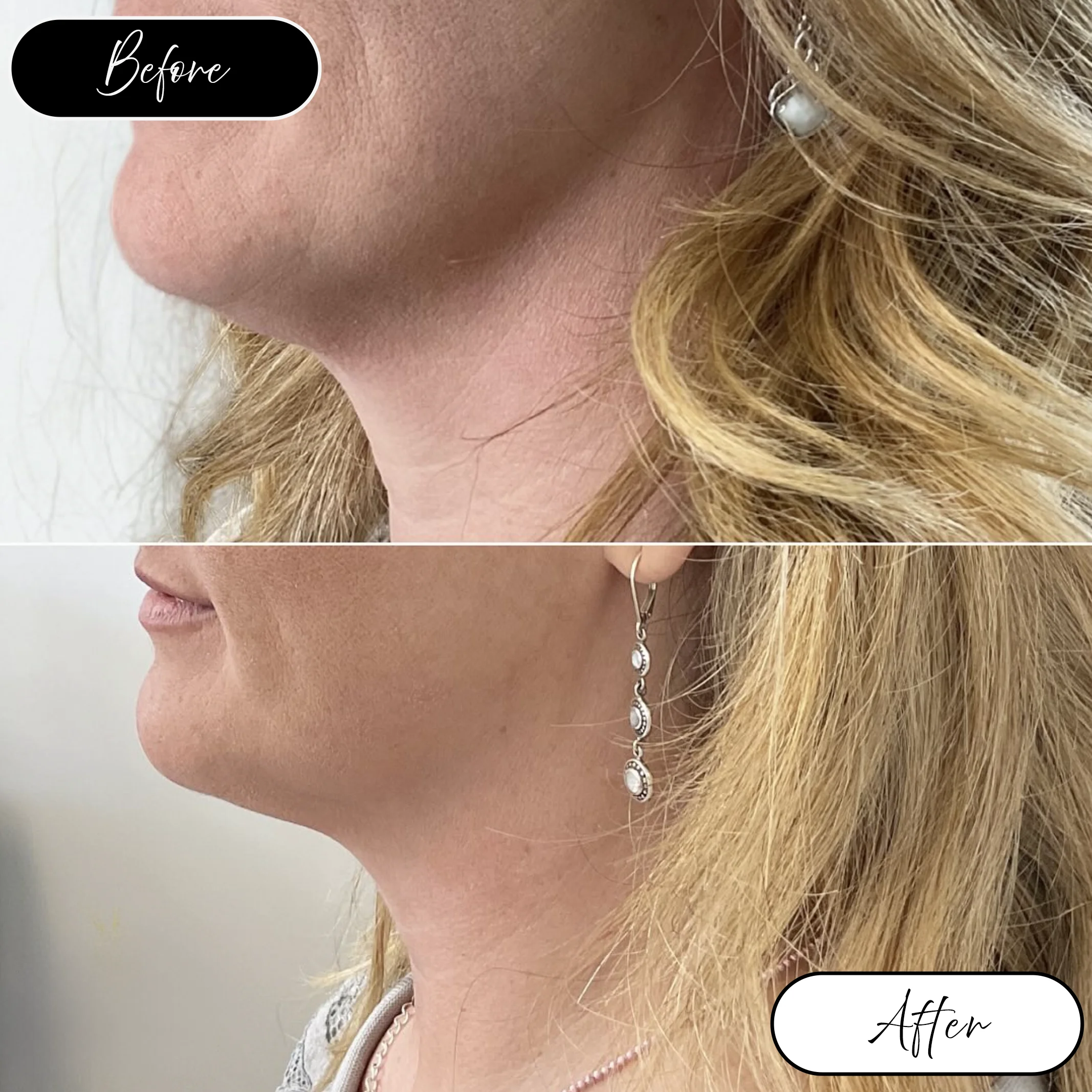 Chin and neck before and after