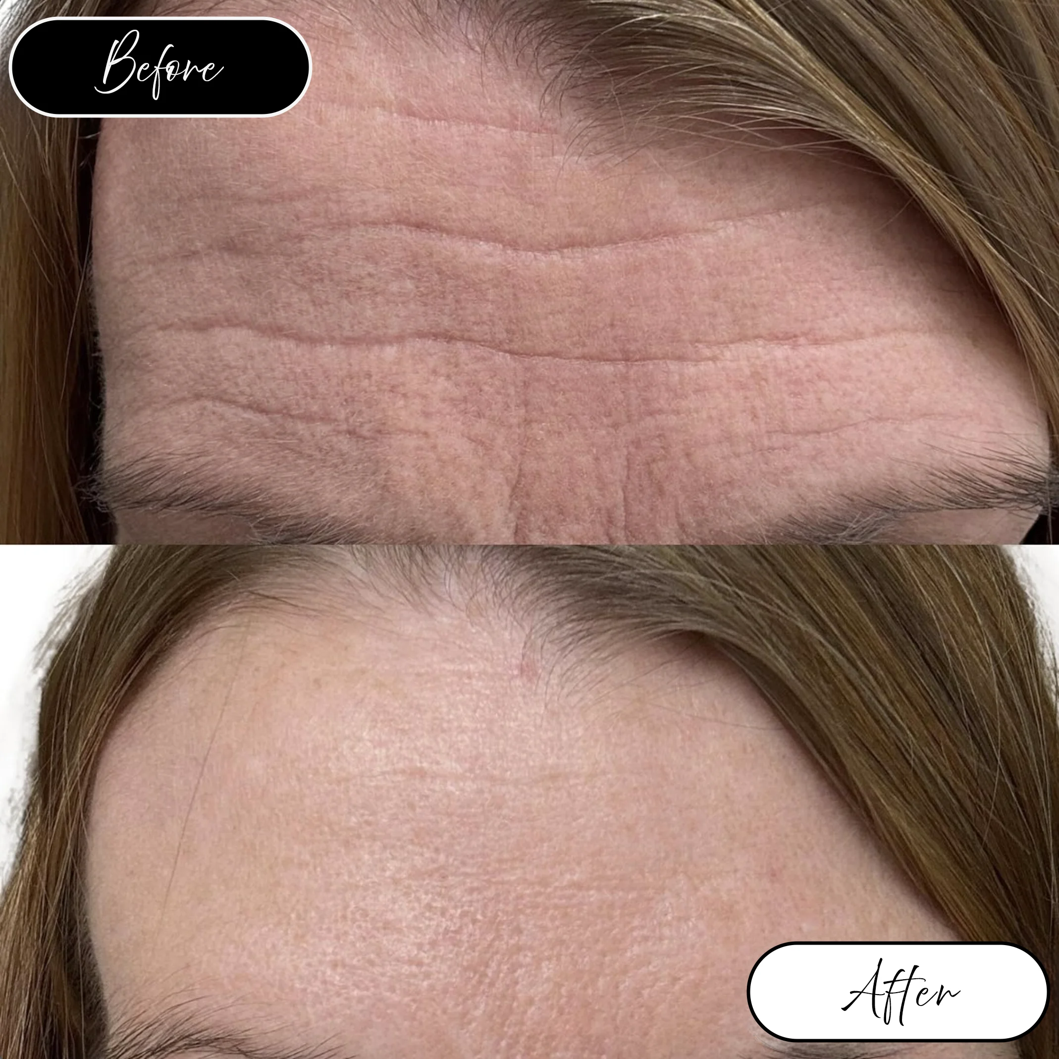 Forehead lines before and after