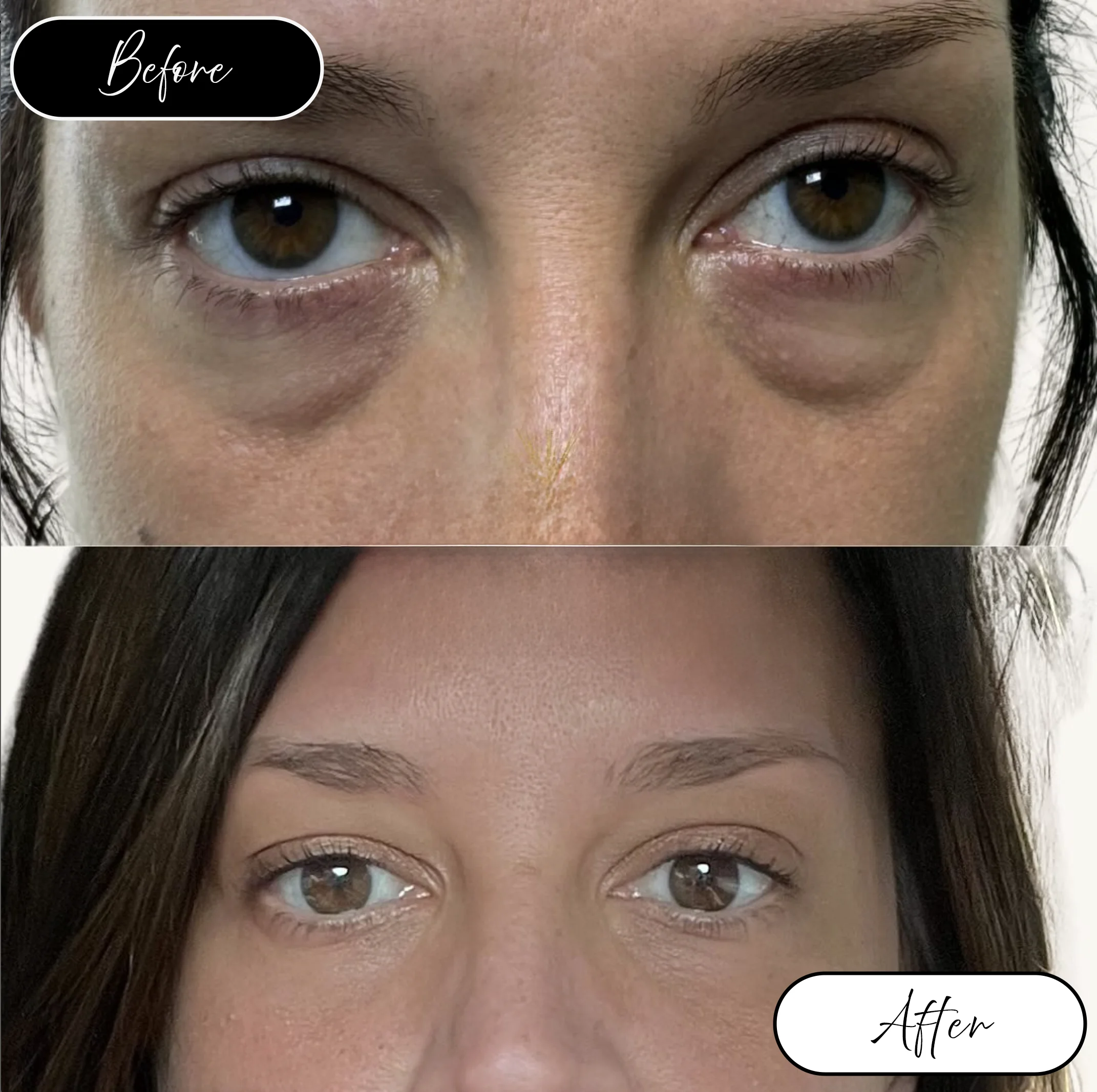 Undereyes before and after
